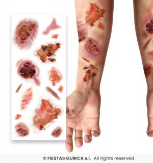 Tatouages blessures chairs à vif infectées