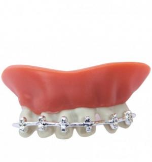 Dentier avec appareil dentaire